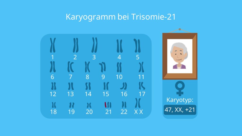 Karyogramm Frau, Trisomie 21, Chromosomenpaare, Mutation