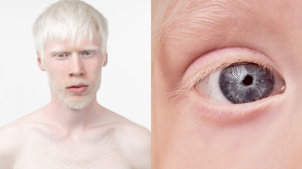 Albinismus, Albinismus mensch, Albinismus menschen, Albino, Albino menschen okulutaner albinismus, okulärer albinismus, Albinismus auge