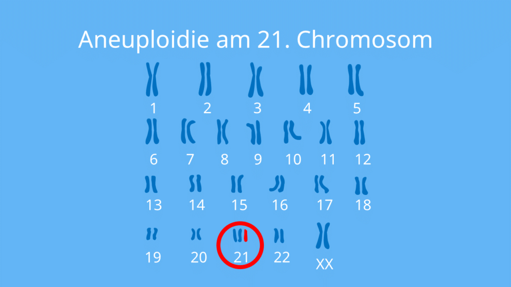 Aneuploidie am 21. Chromosom, Trisomie 21, Down Syndrom, Aneuploidie, Genommutation, Chromosomenaberration, Chromosom, Karyogramm